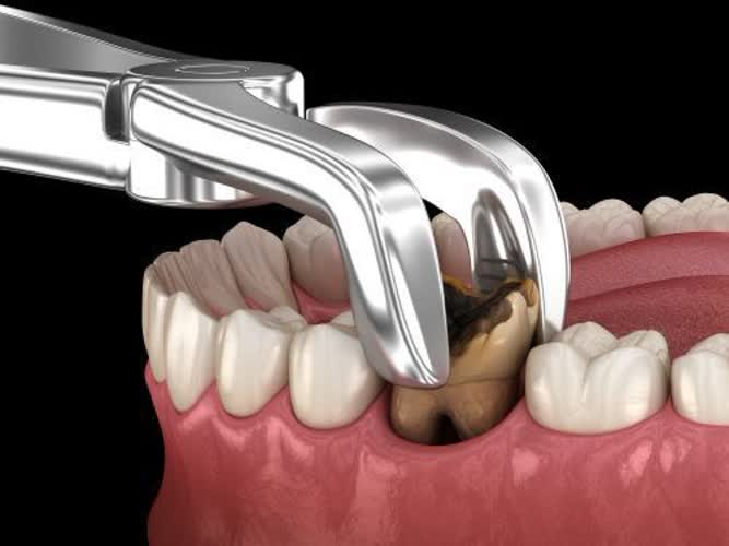دندان پوسیده