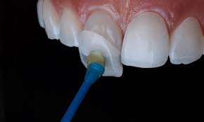 لمینیت کامپوزیت دندانپزشکی فردیس